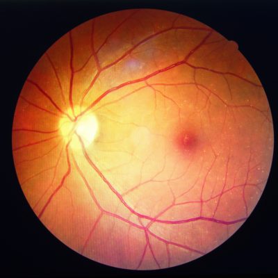 diabetes retinopathy.